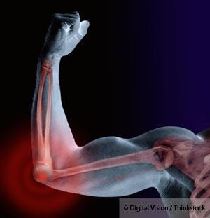 Huesos y Osteoporosis
