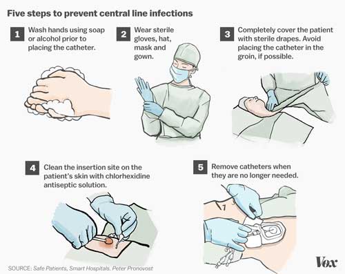 Steps to Prevent Central Line Infection