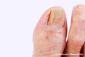 What are some reasons why fingernails have bumps?