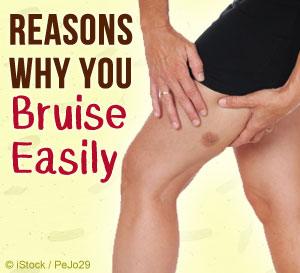 why you bruise easily