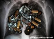 Lung Cancer Risk