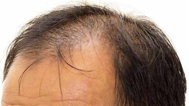 saw palmetto for alopecia