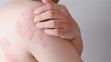 histamine to blame for headache hives heartburn