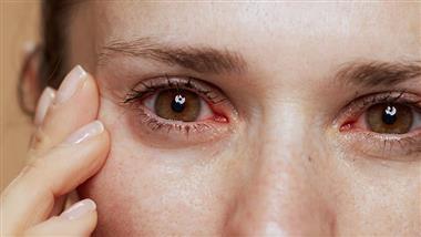 remedies to prevent dry eyes