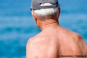 The Surprising Cause of Melanoma (And No, it's Not Too Much Sun)