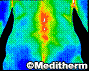 Thermography Detect Back Pain