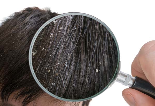 how to get rid of dandruff