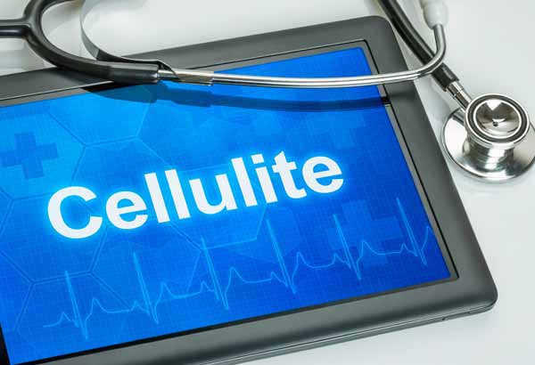 what causes cellulite