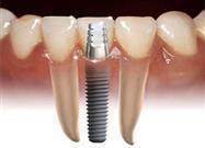 tooth implant