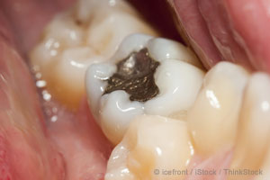 Metal Fillings in Your Mouth Could Make You Really Sick