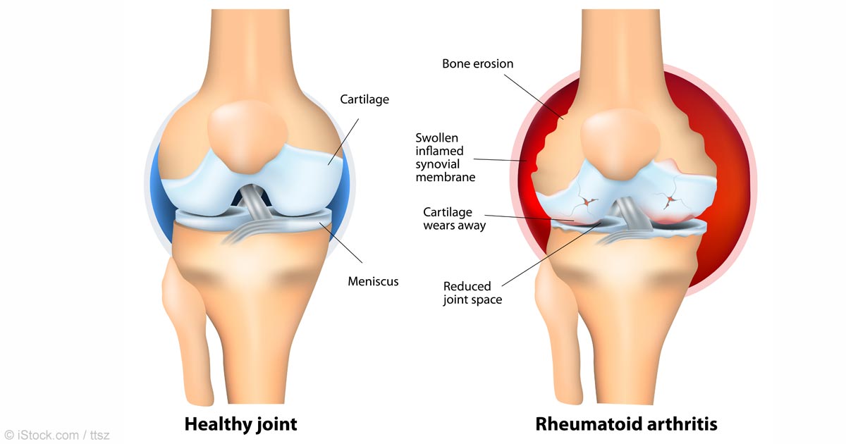 How to Put Rheumatoid Arthritis into Remission