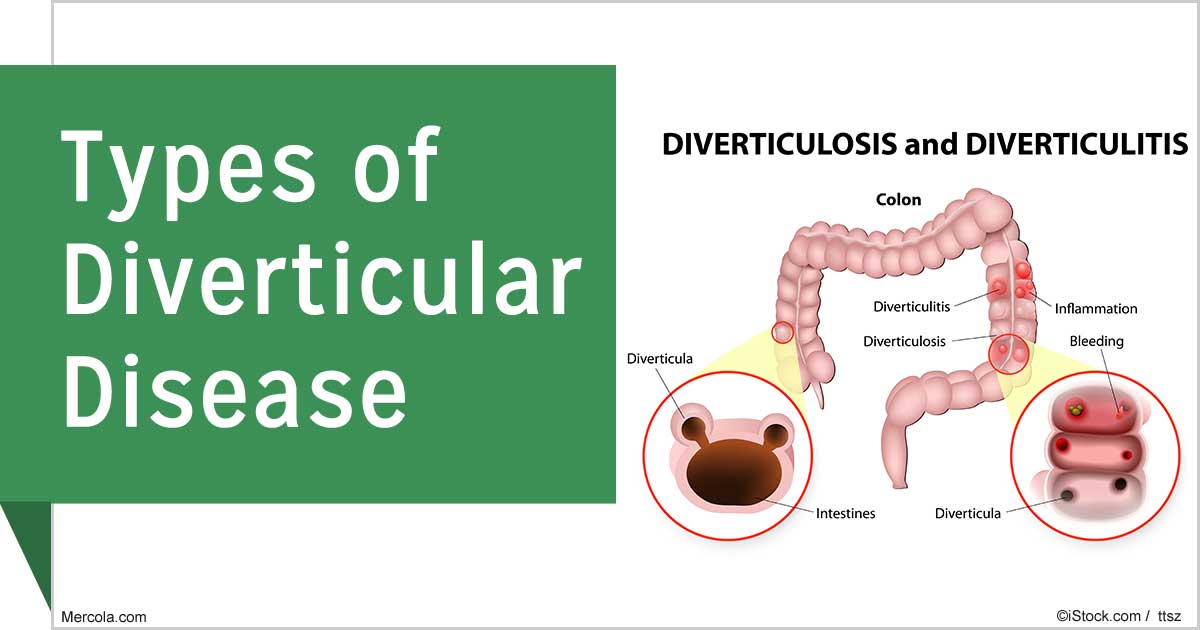 What Are the Different Types of Diverticular Disease?