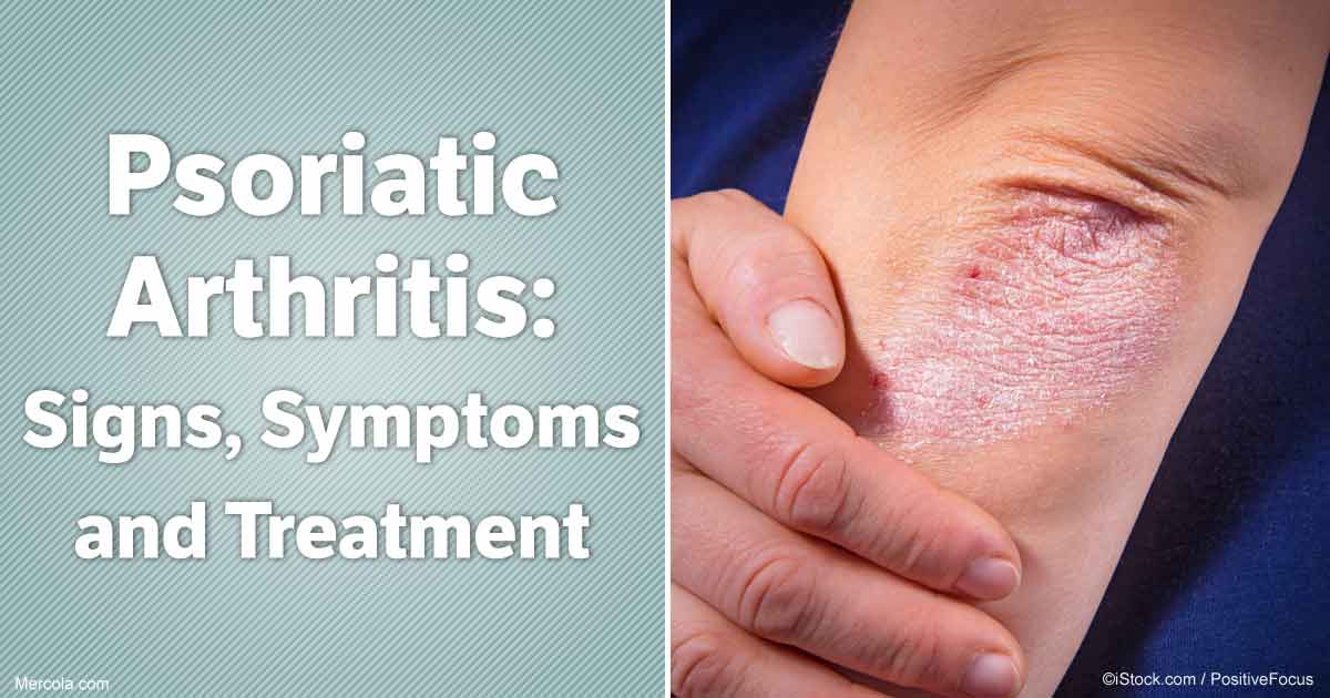 Psoriatic Arthritis: The Agonizing Duo of Skin and Joint Pain