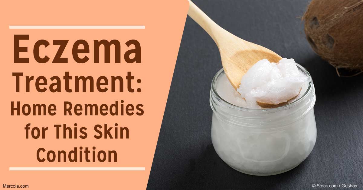 eczema treatment for scalp