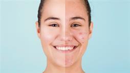 acne home remedies: before and after