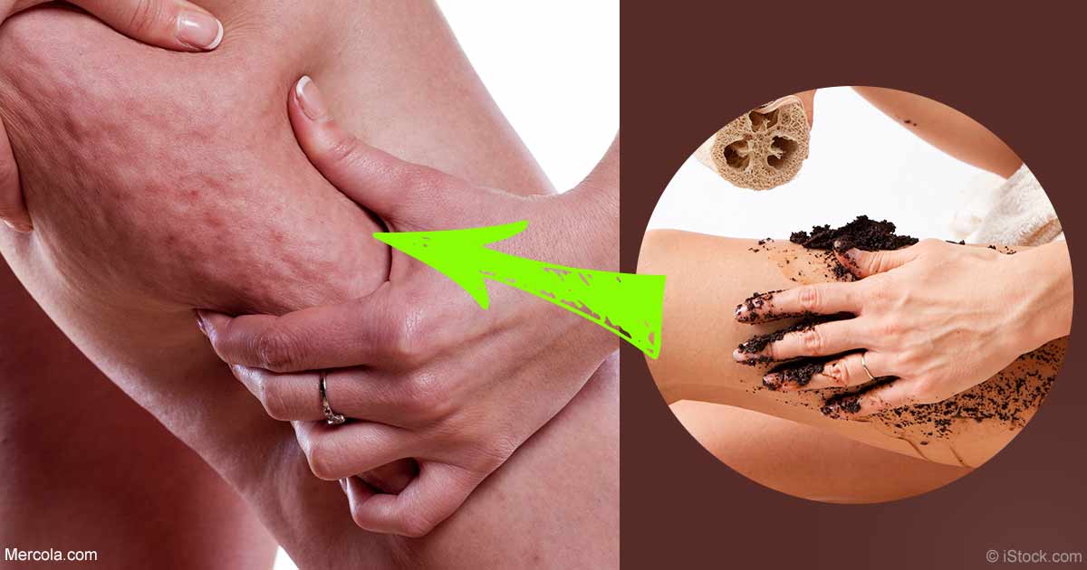 What Causes Cellulite And Can It Go Away