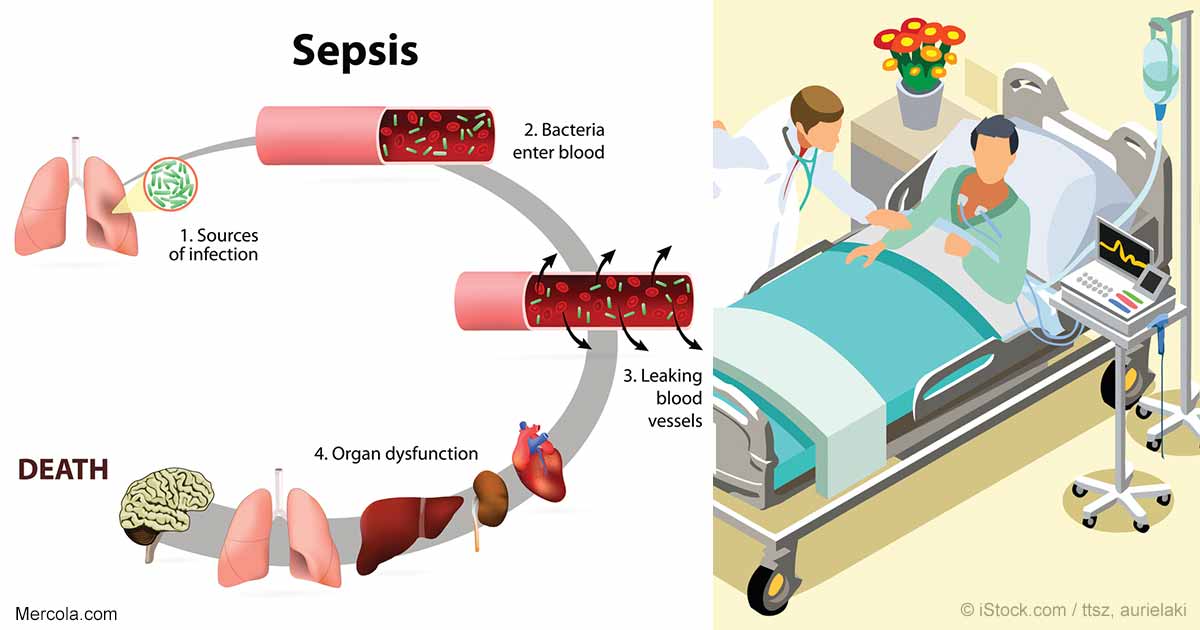 Vitamin C - A Game Changer in Treatment of Deadly Sepsis