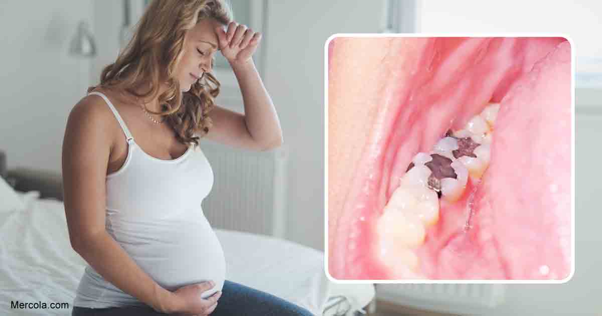 Dental Fillings Linked to Pregnancy Risk
