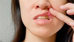 All You Need to Know About Canker Sores: An Introduction