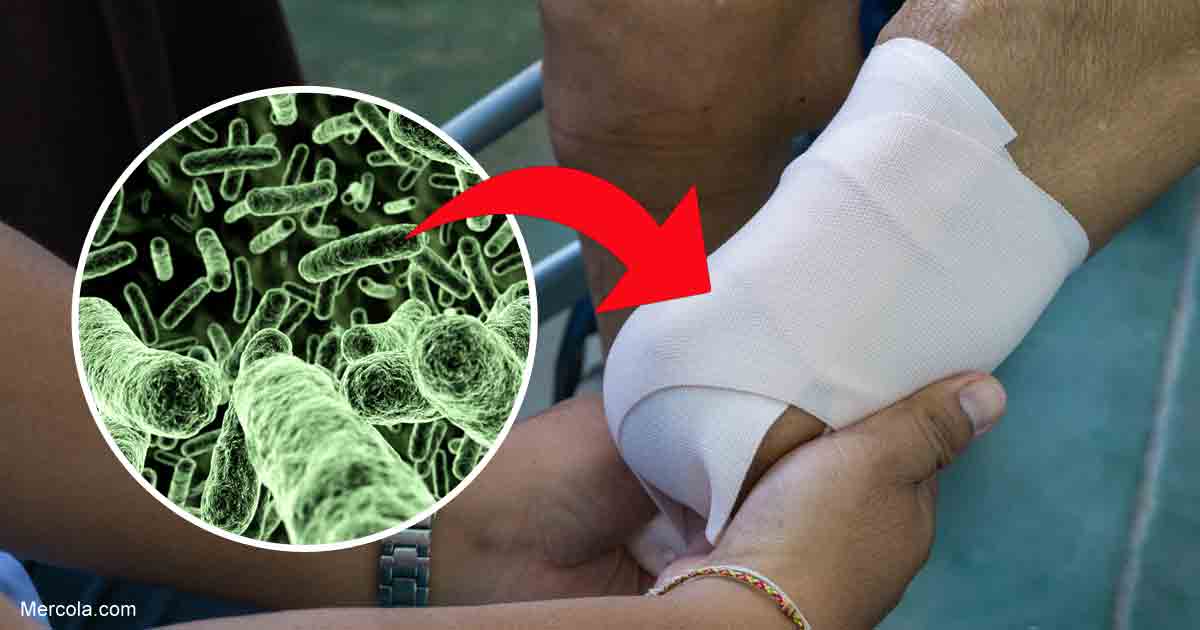 Flesh-Eating Bacteria Can Attack Those With Excess Iron