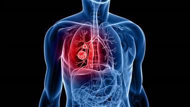 vitamina E y cancer de pulmon