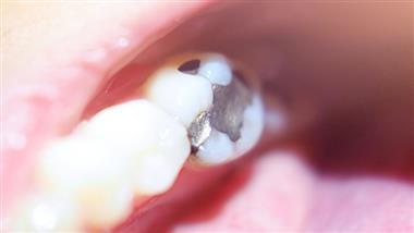 do dentists still use mercury fillings