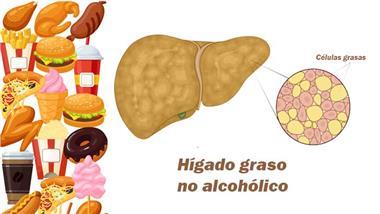 fructosa enfermedad del hígado graso no alcohólico en niños NAFLD
