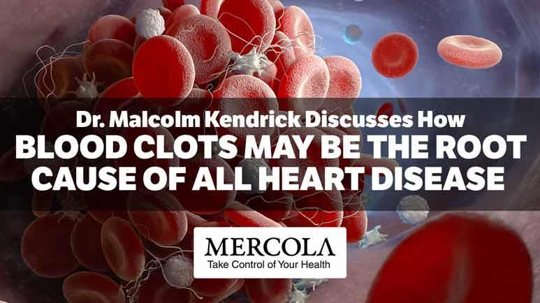 Blutgerinnsel können die Hauptursache für Herzkrankheiten sein