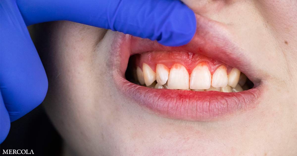 Gum Disease Increases Risk of Mental Health Problems by 37%