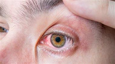 ocular toxoplasmosis
