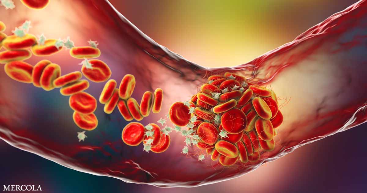 Are Fibrinolytics Key to Preventing Clogged Arteries?
