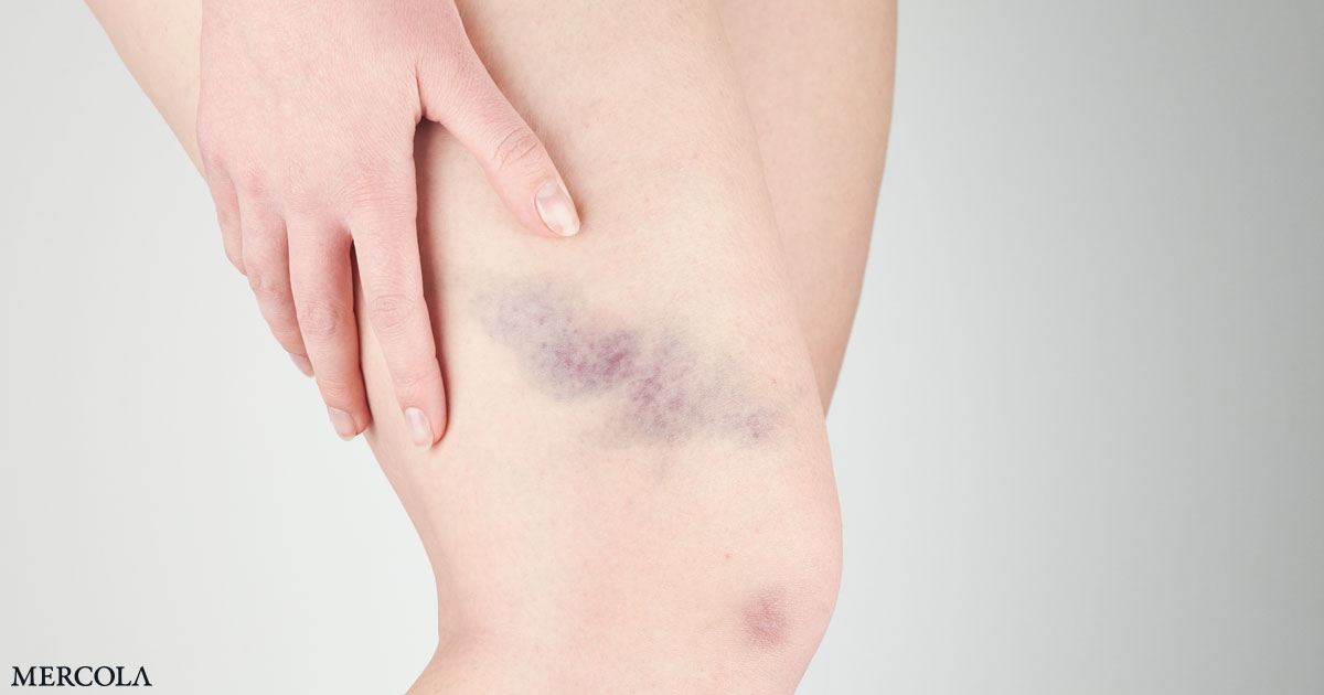 9 Reasons Why You Bruise Easily