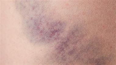 reasons why you bruise easily