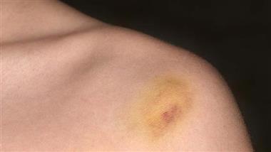 yellow bruise