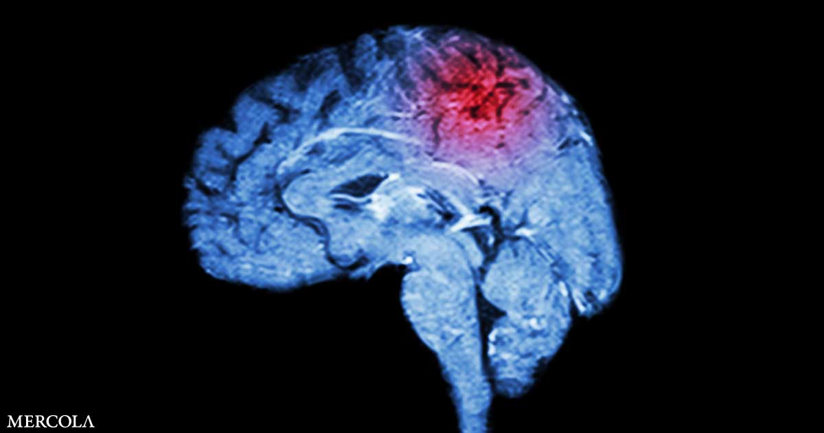 Even Mild Head Injuries Increase Risk for Parkinson's Disease