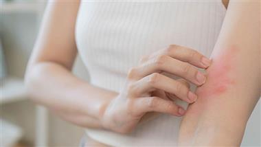 hives root cause