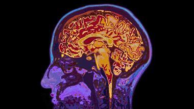 ibd dementia link