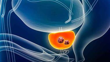 microplastics prostate tumor