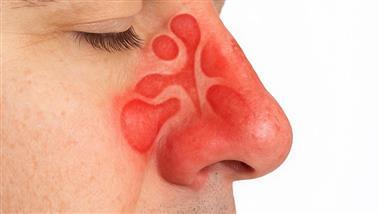natural ways to manage sinusitis