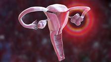 what to do diagnosed with an ovarian cyst
