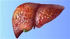The Link Between Vitamin D Deficiency and Fatty Liver