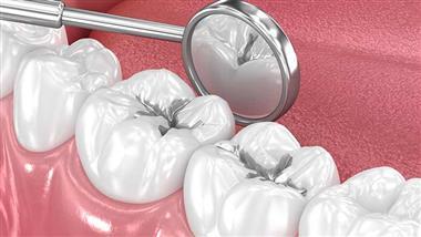 mercury free dentistry week dental amalgam ban