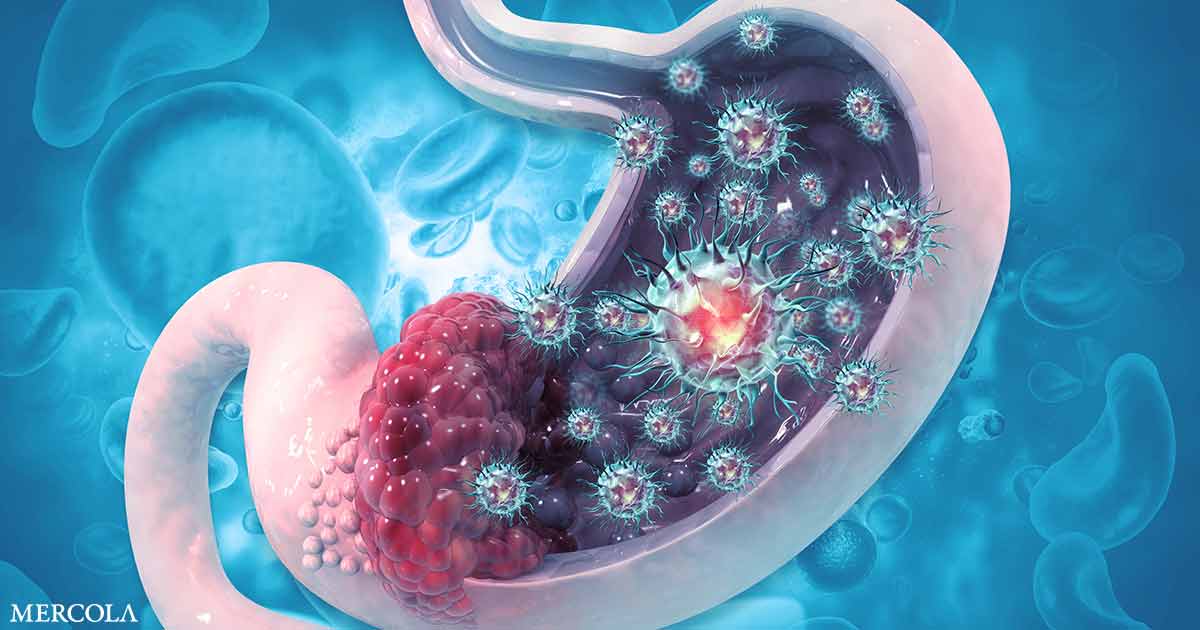 Oxidative Stress and Oral Bacteria Help Set the Stage for Stomach Cancer