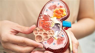 bacteria role kidney stone formation