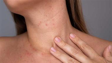 hidradenitis suppurativa edc plastics food