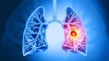 high gi foods lung cancer risk