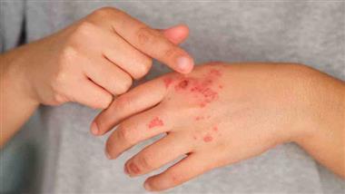progesterone dhea psoriasis