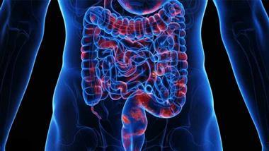 ultraprocessed foods crohns disease risk