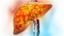 fatty liver disease