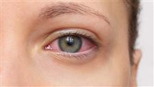 dry eyes treatment